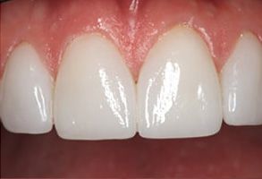 Simonetti and Domozych DDS, PC | Pediatric Dentistry, Implant Restorations and Veneers