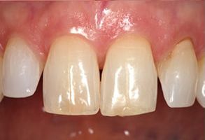 Simonetti and Domozych DDS, PC | Fluoride Treatment, Crowns  amp  Caps and Preventative Program